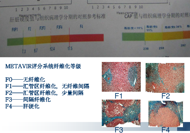 河南医院院附属医院肝病医生解读:肝脏硬度值